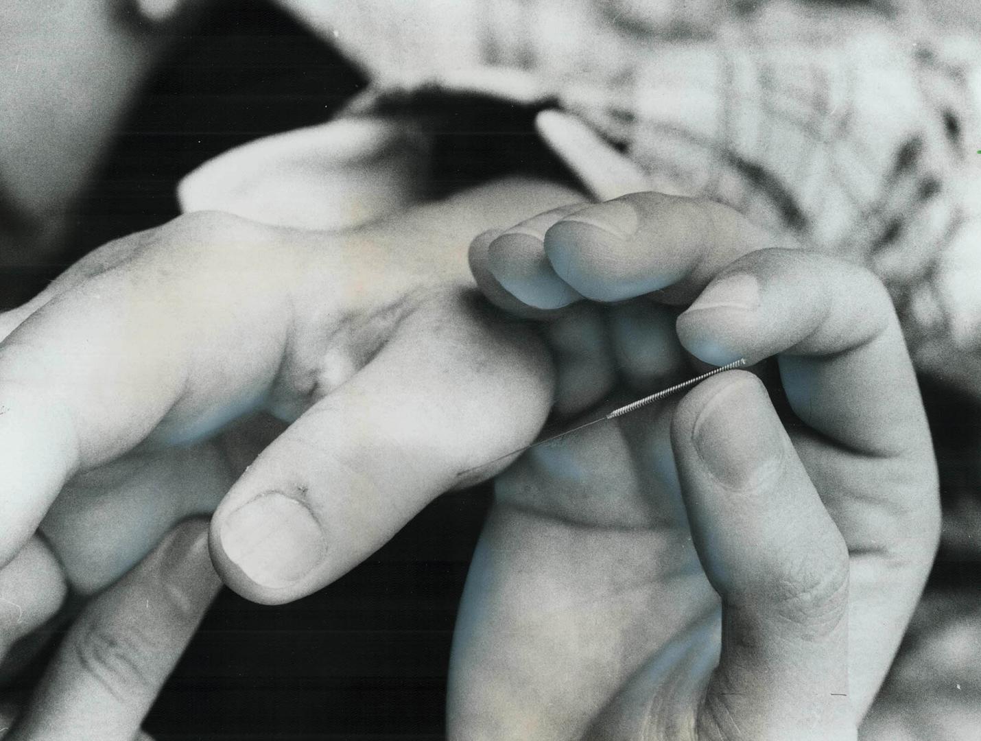 Acupuncture needle is inserted in patient's hand