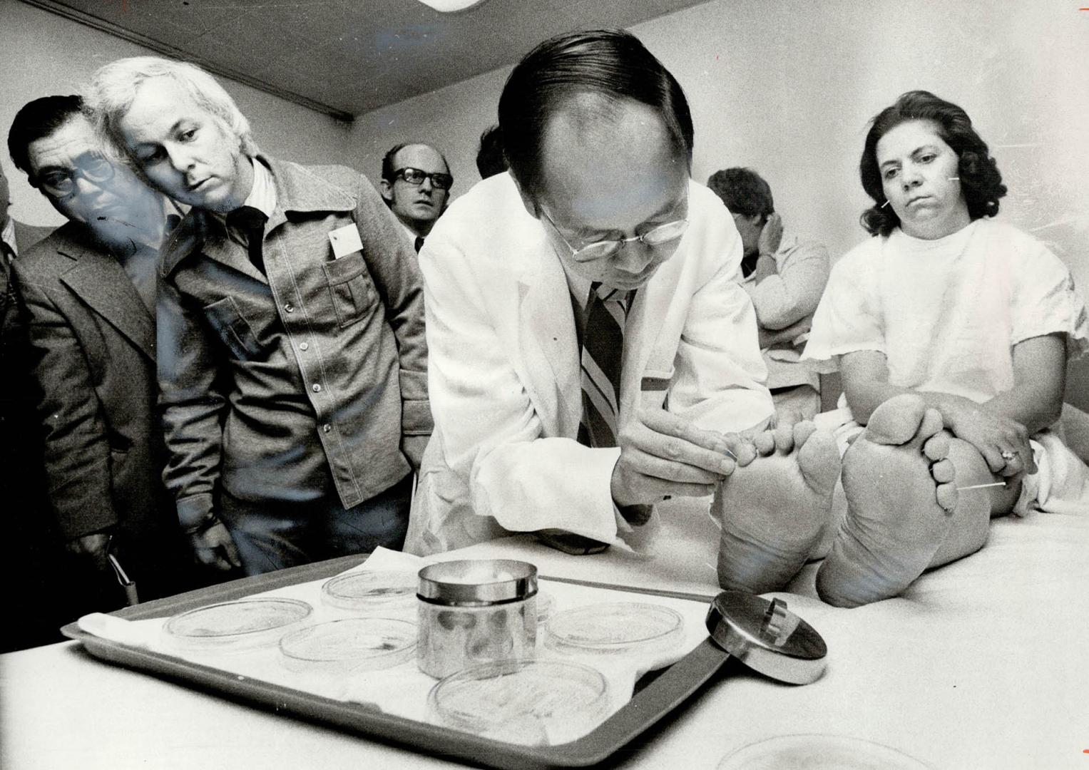 Acupuncture treatments are studied by Dr. Edward Sheffman (left), former patient attending a three-day course for Ontario doctors at Wellesley Hospita(...)